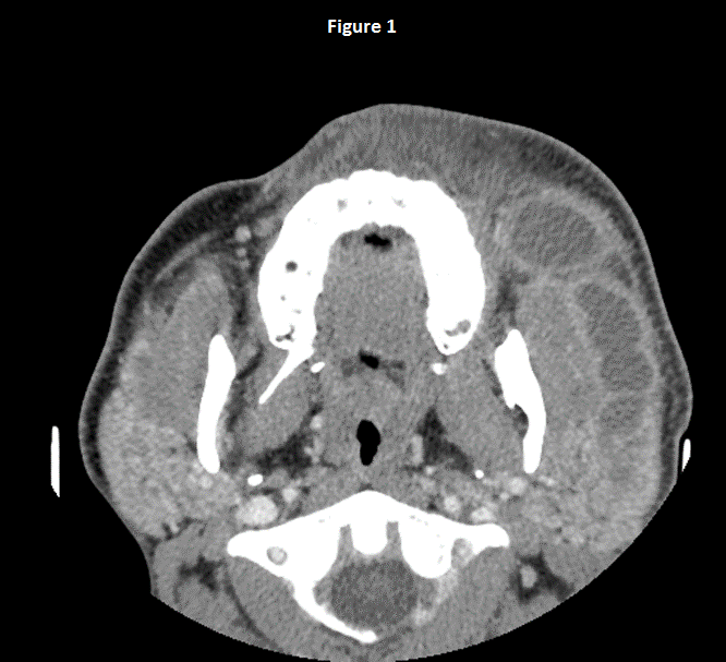 Case Study 3 Parotid Duct Abscess University Of Mississippi Medical